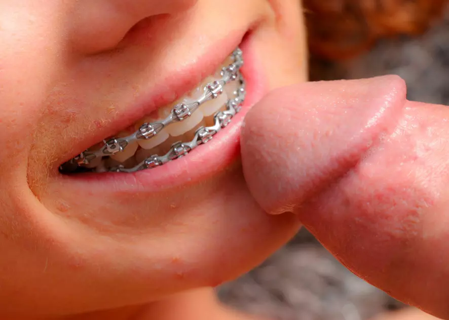 bradley caldwell recommends redhead braces porn adele roets add redhead braces porn photo